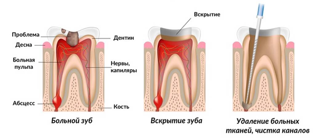 Почему болит зуб после мышьяка