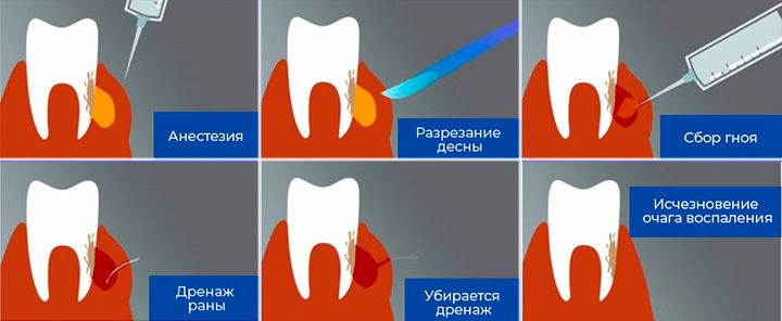 Периостит зуба
