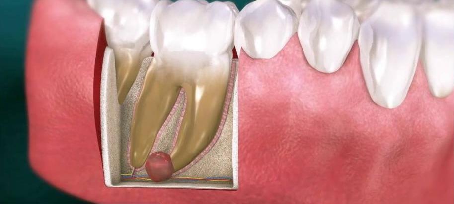 Киста на десне — стоматологическая патология, которая требует своевременного лечения