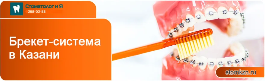 Брекет-система в Казани. Исправление прикуса Брекет-система от «Стоматолог и Я».