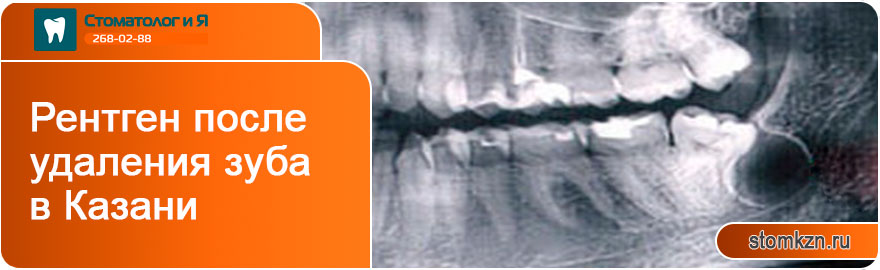 Рентген после удаления зуба в Казани от «Стоматолог и Я». С использованием высококачественного оборудования. 