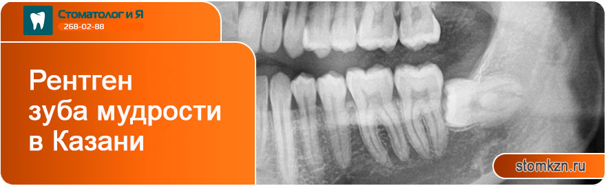 Рентген после удаления зуба мудрости в Казани от «Стоматолог и Я». С использованием высококачественного оборудования.