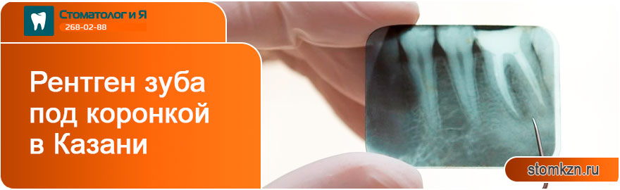 Рентген зуба под коронкой в Казани от «Стоматолог и Я». С использованием высококачественного оборудования. 